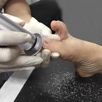 Professional Callus Remover
